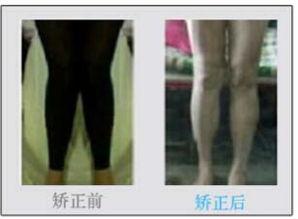 成人o型腿视频,从成因到康复,视频揭秘矫正过程